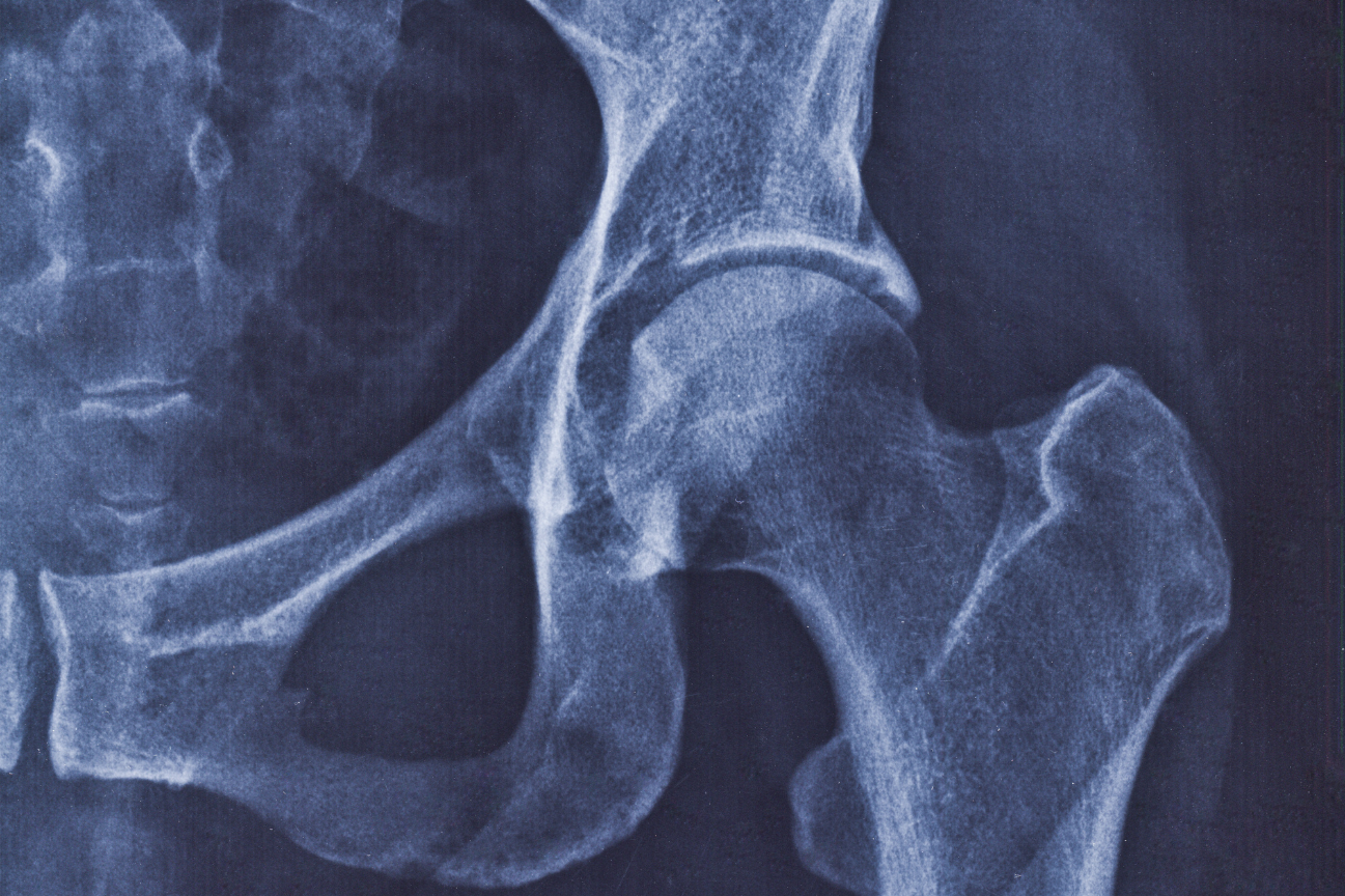 Radiologie d'une coxarthrose
